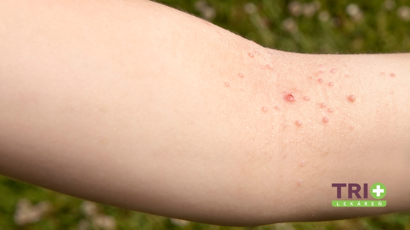 Kožná vyrážka spôsobená Molluscum contagiosum na vnútornej strane predlaktia.