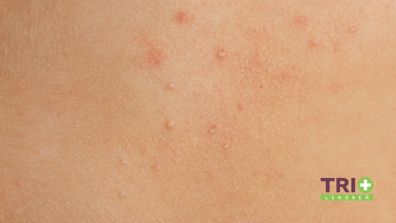 Molluscum contagiosum - drobné perlovité vyrážky na koži.