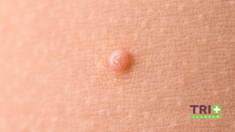 Detail vyrážky spôsobenej Molluscum contagiosum na koži.